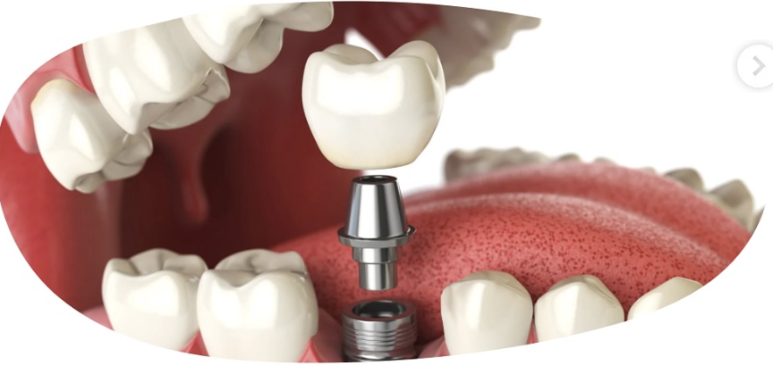 Implantes Dentales